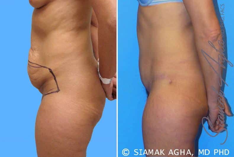 Tummy Tuck Before & After