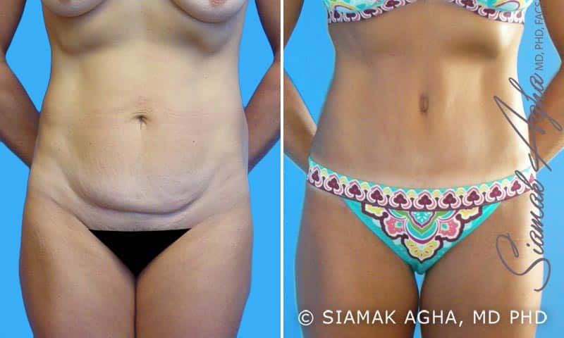 Tummy Tuck Before & After