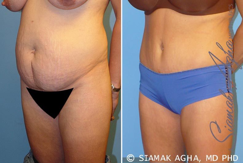 Tummy Tuck Before & After