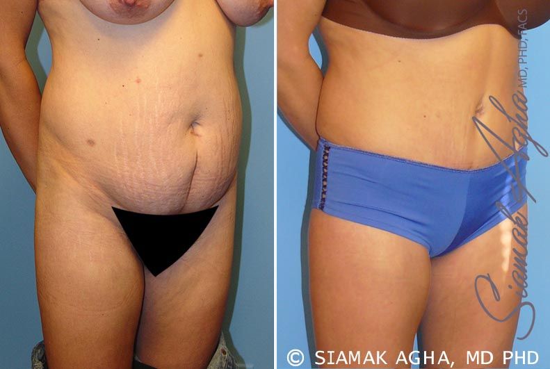 Tummy Tuck Before & After