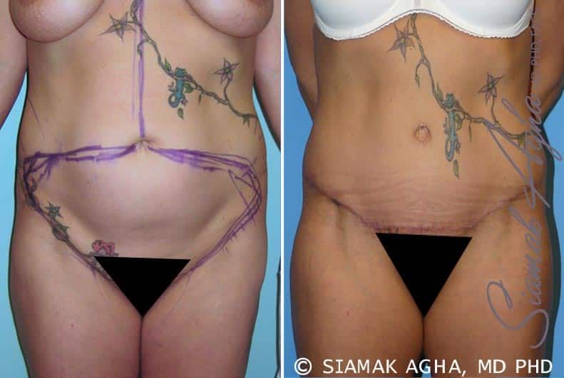Tummy Tuck Before & After
