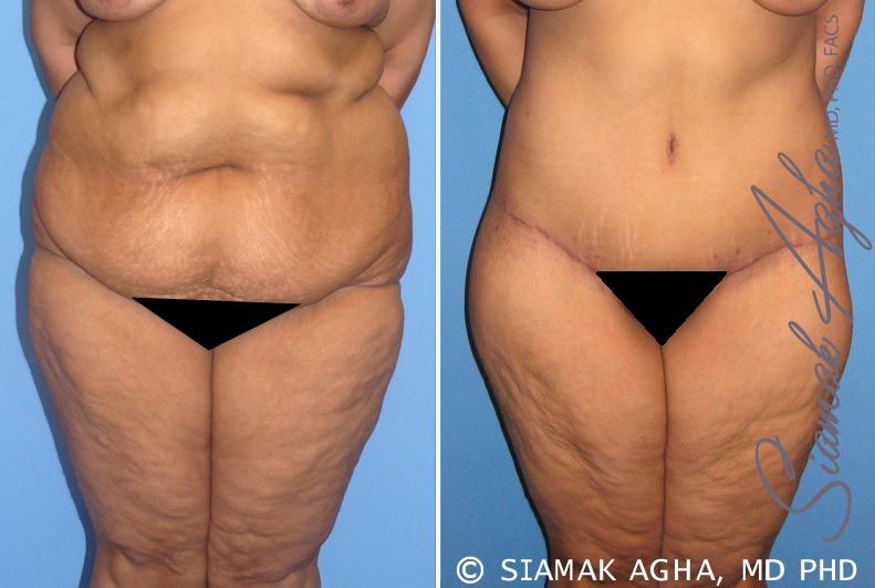 Tummy Tuck Before & After
