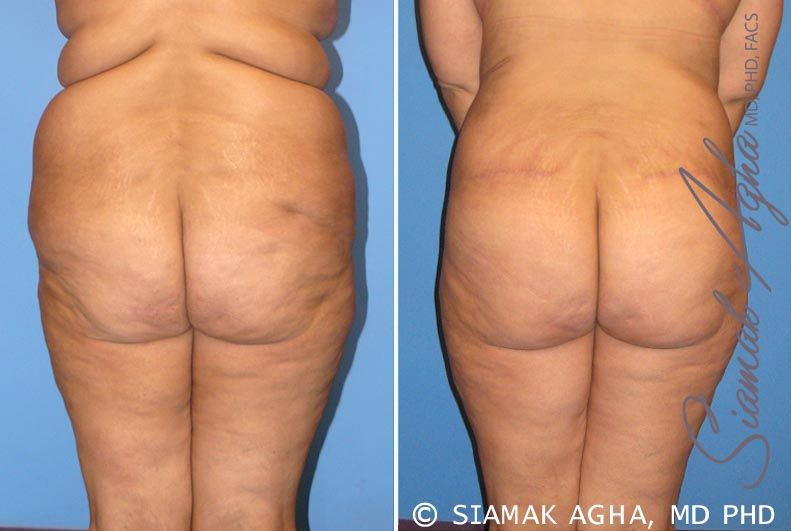 Tummy Tuck Before & After