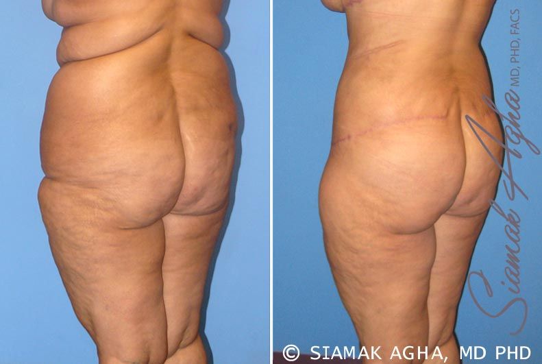 Tummy Tuck Before & After