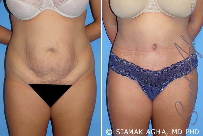 Tummy Tuck Before & After