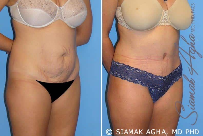 Tummy Tuck Before & After