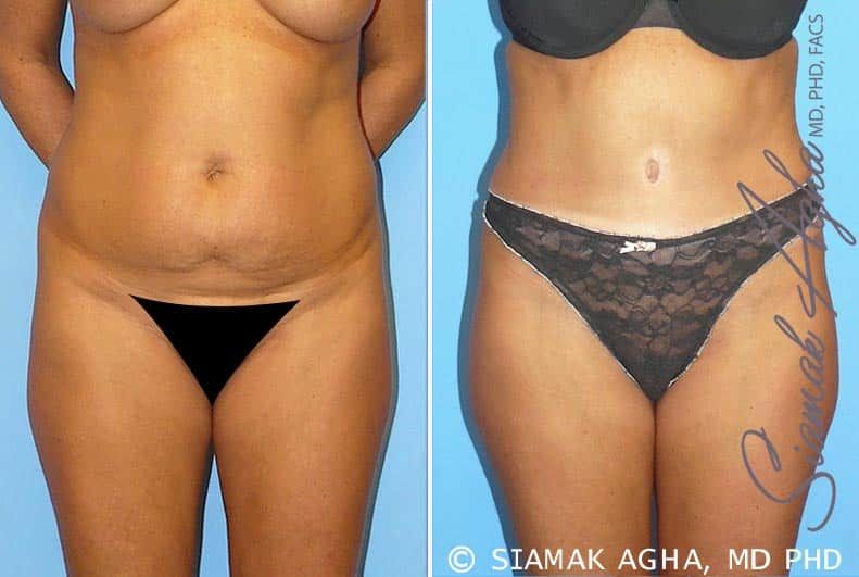 Tummy Tuck Before & After