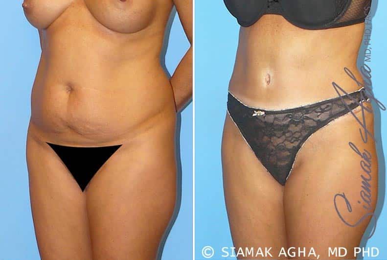 Tummy Tuck Before & After