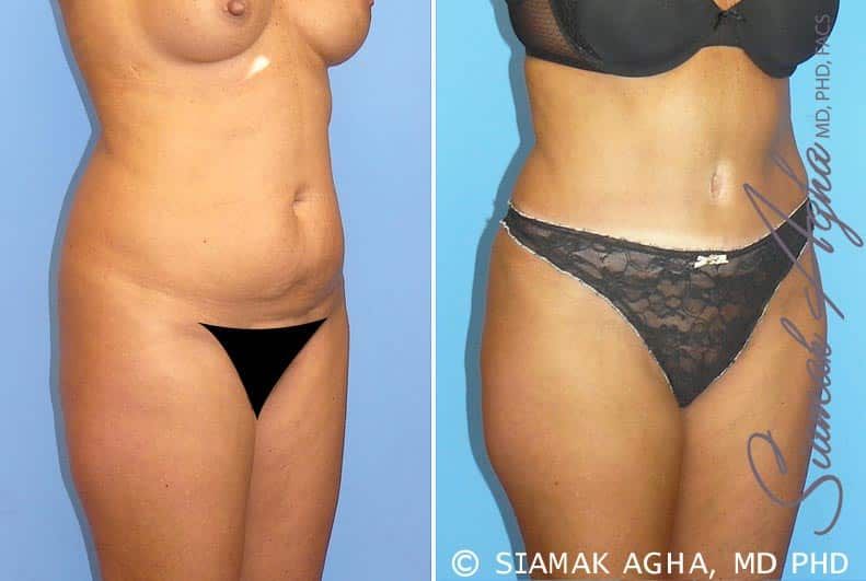 Tummy Tuck Before & After