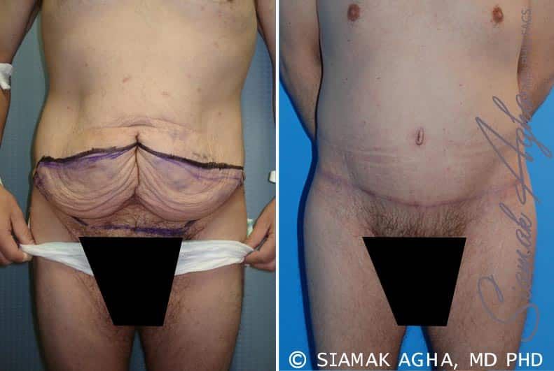 Tummy Tuck Before & After