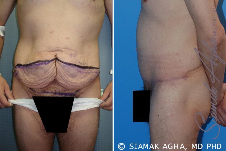 Tummy Tuck Before & After