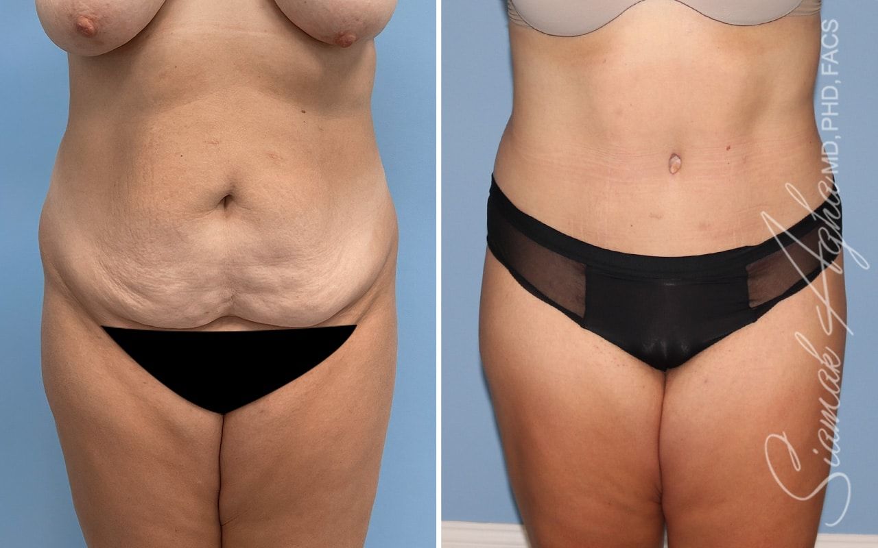 Tummy Tuck Before & After