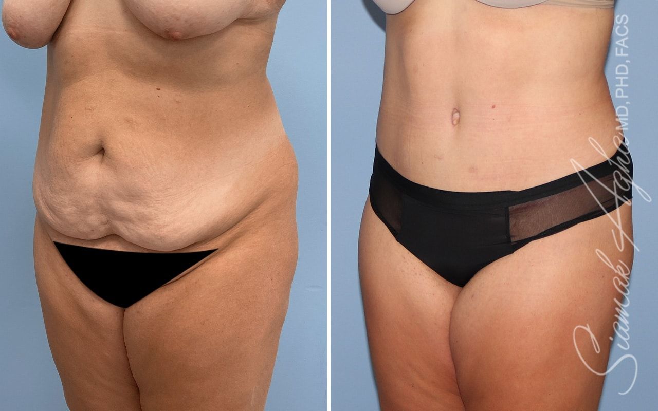 Tummy Tuck Before & After