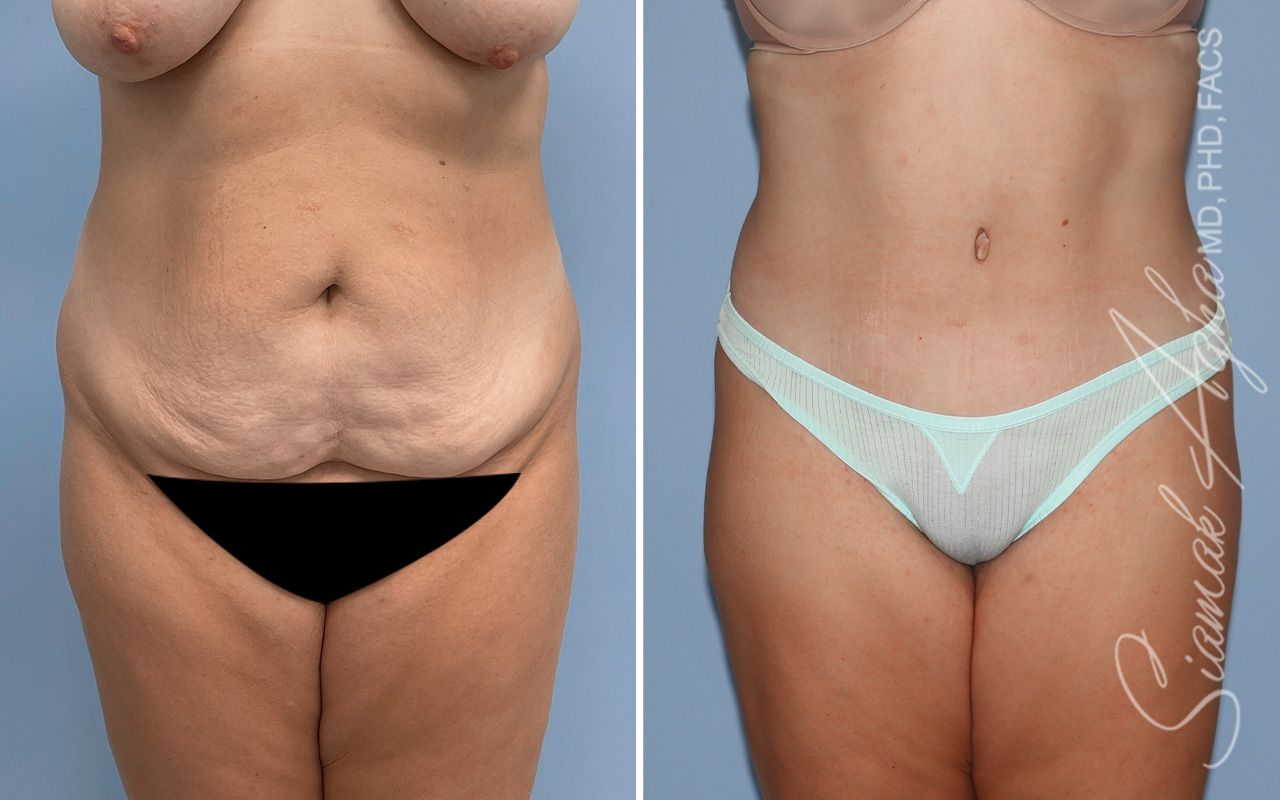 Tummy Tuck Before & After