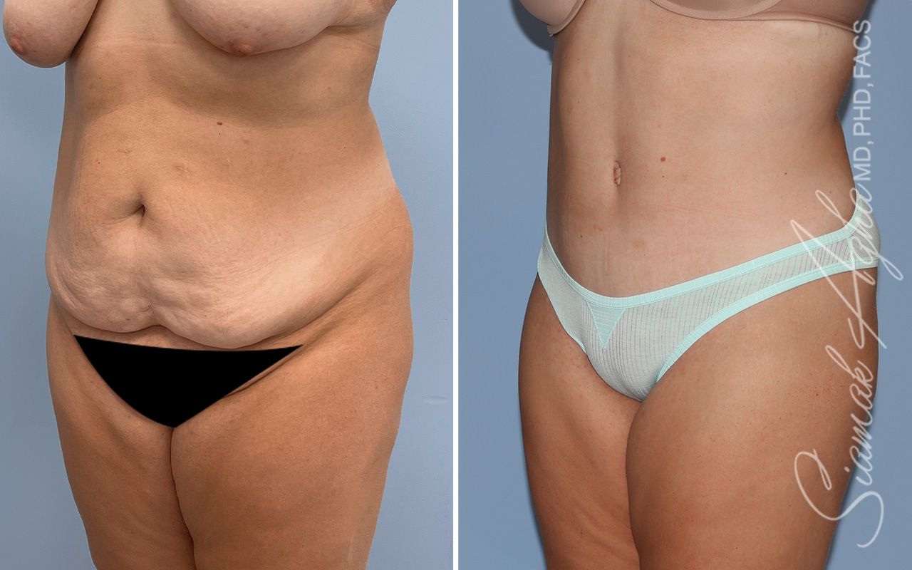 Tummy Tuck Before & After