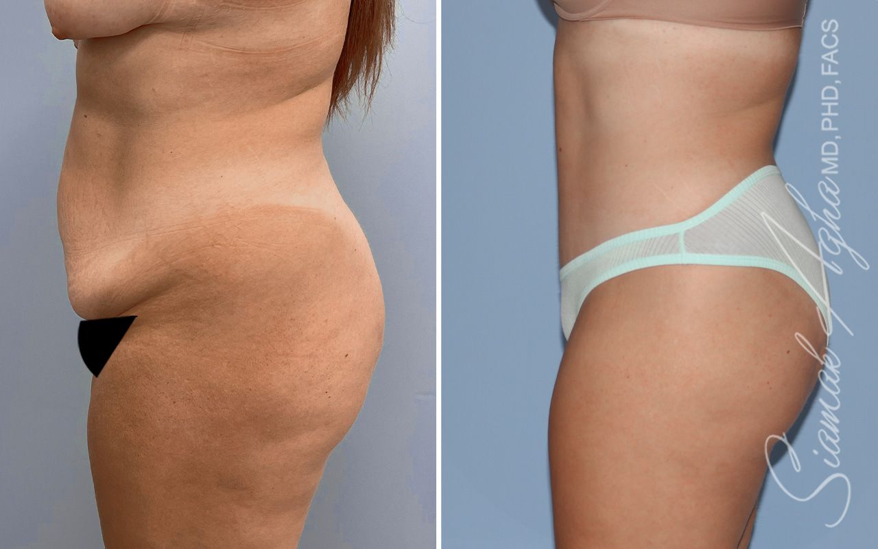 Tummy Tuck Before & After