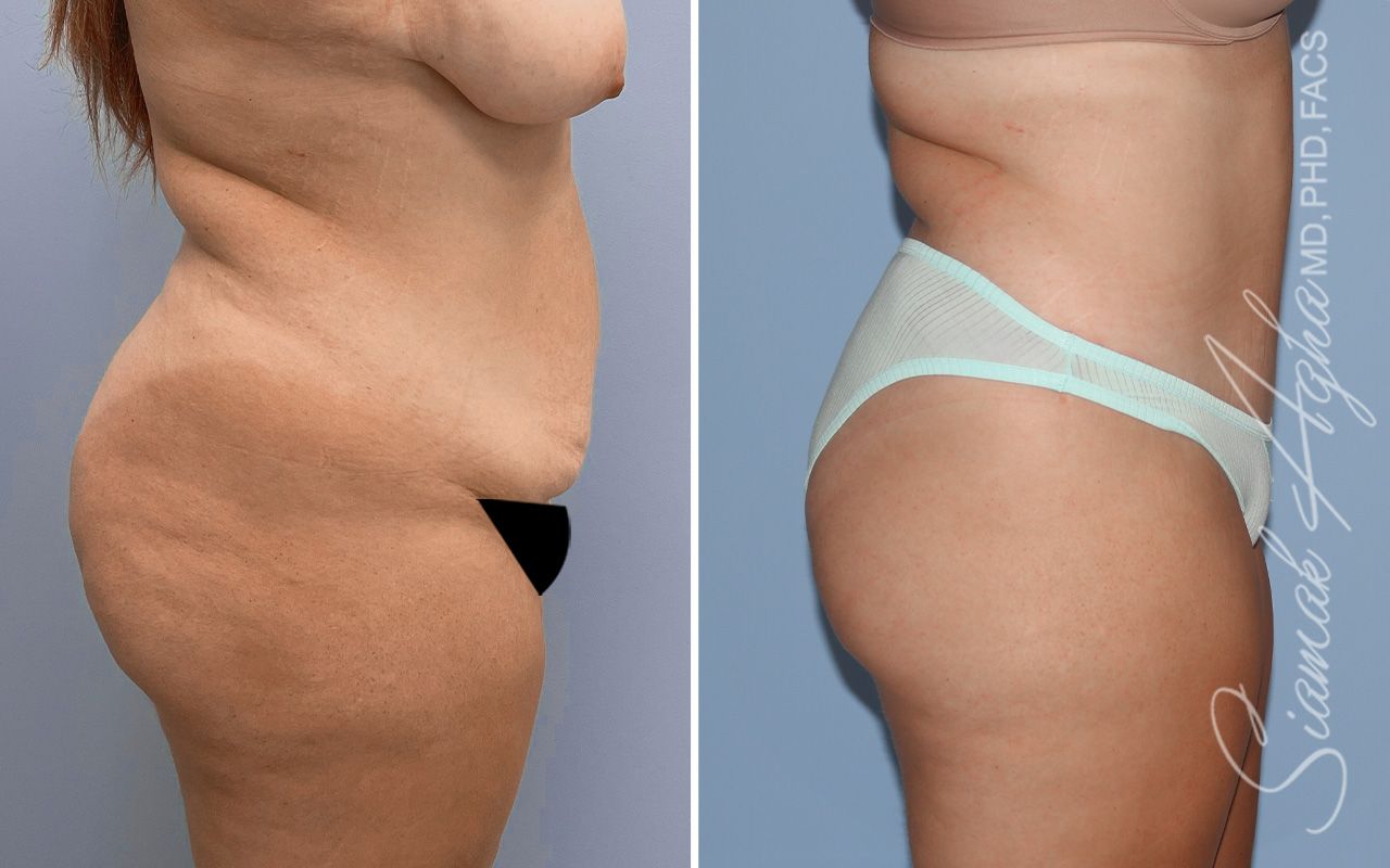 Tummy Tuck Before & After