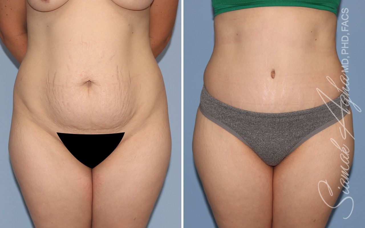 Tummy Tuck Before & After