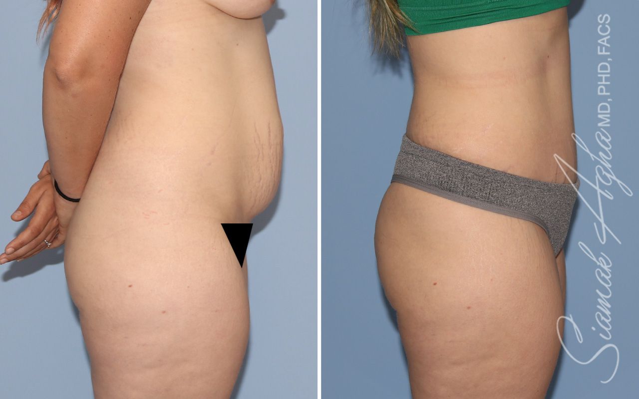Tummy Tuck Before & After