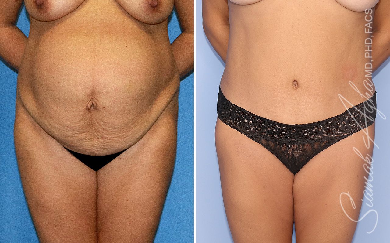 Tummy Tuck Before & After