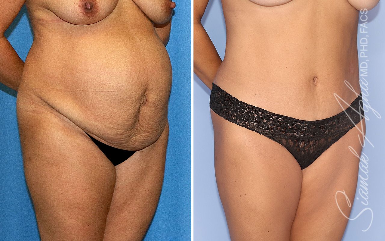 Tummy Tuck Before & After