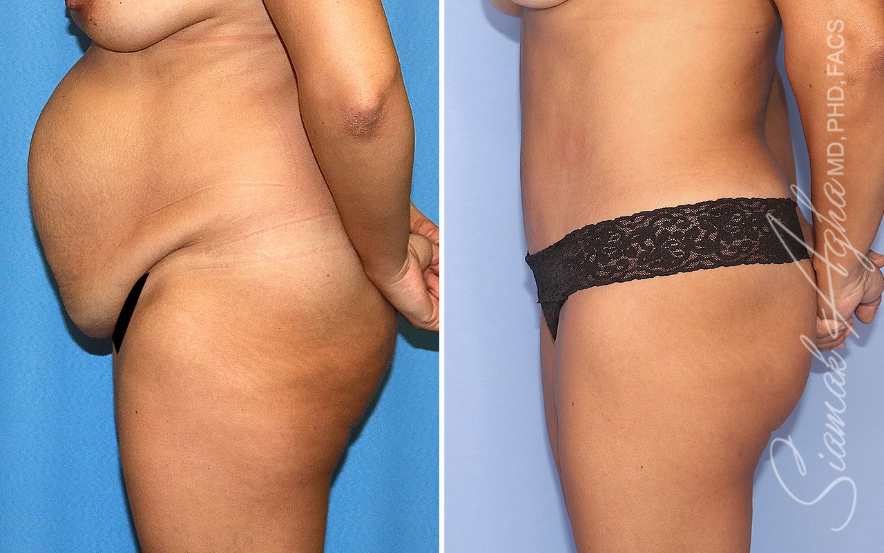 Tummy Tuck Before & After