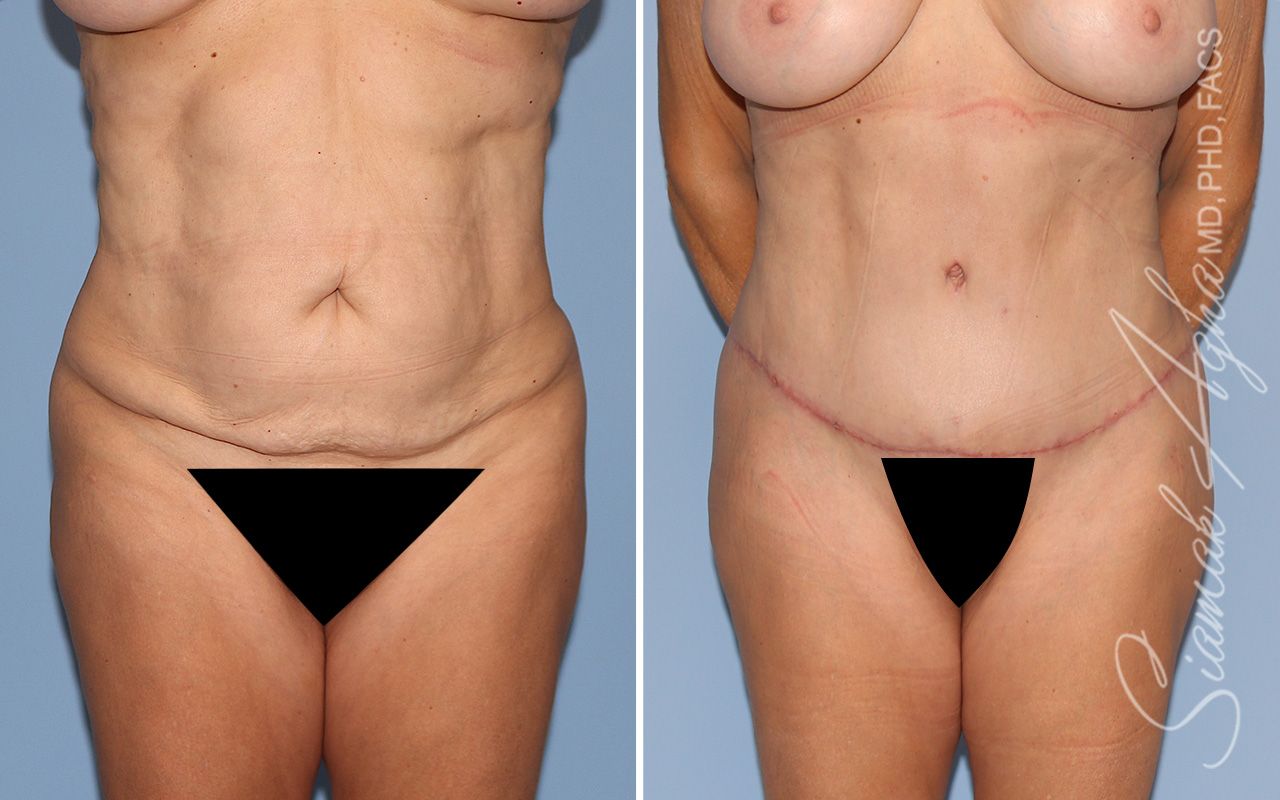 Tummy Tuck Before & After
