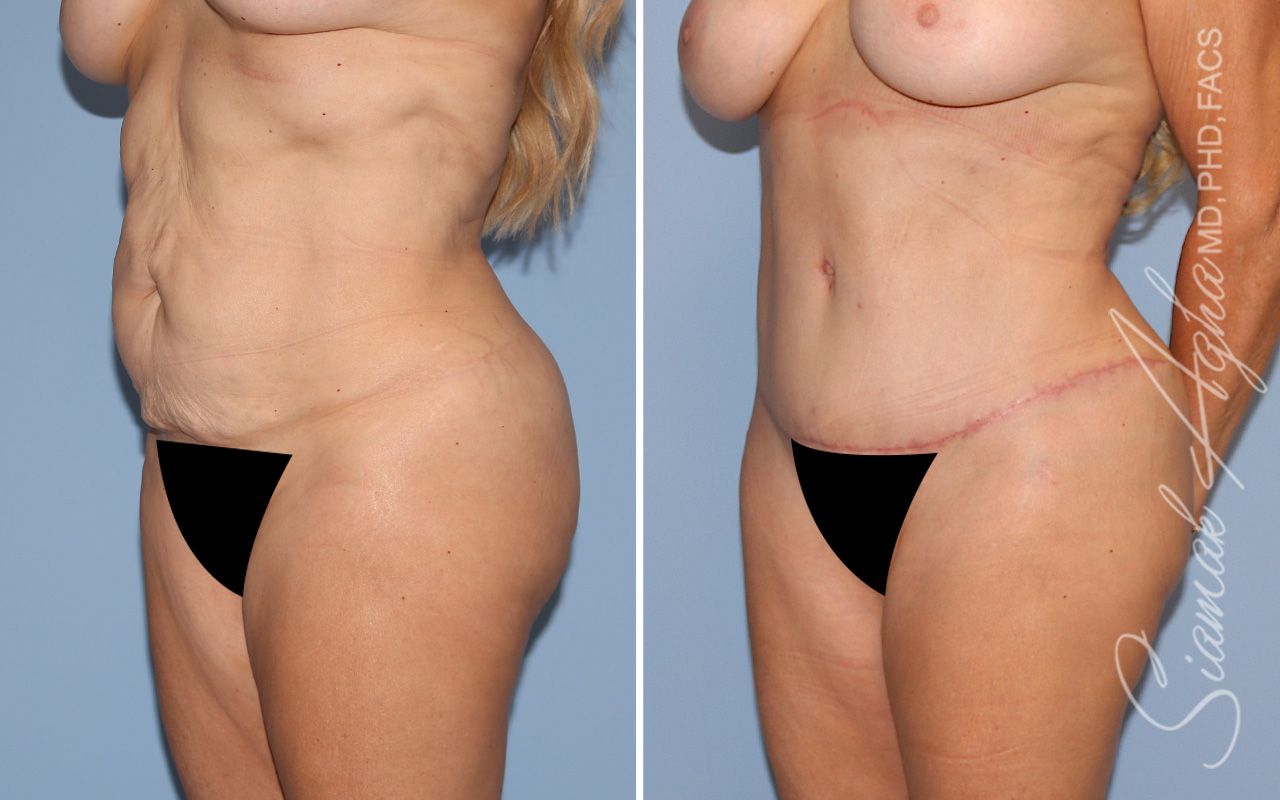 Tummy Tuck Before & After