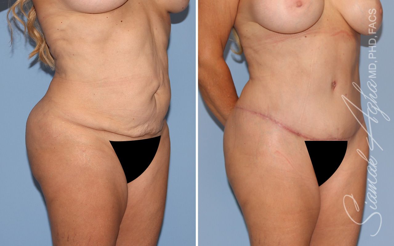 Tummy Tuck Before & After