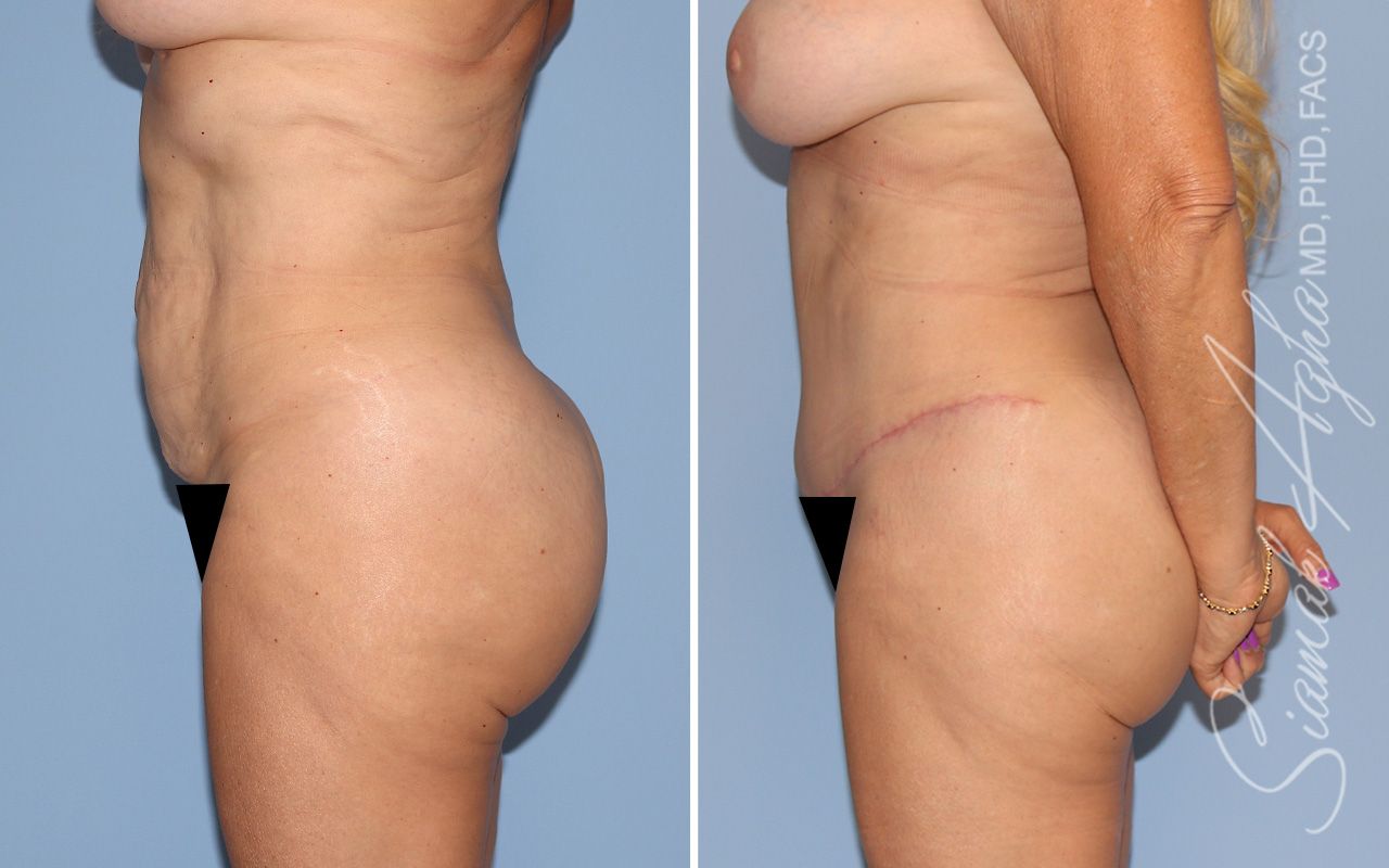 Tummy Tuck Before & After