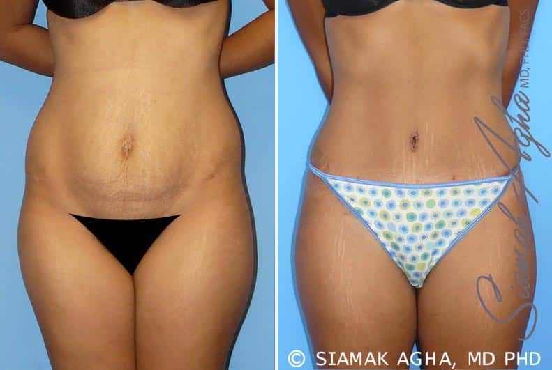 Tummy Tuck Before & After