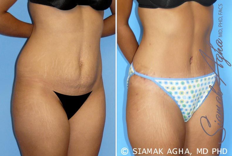 Tummy Tuck Before & After