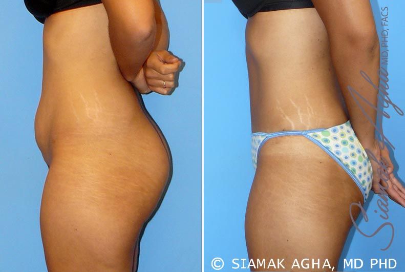 Tummy Tuck Before & After