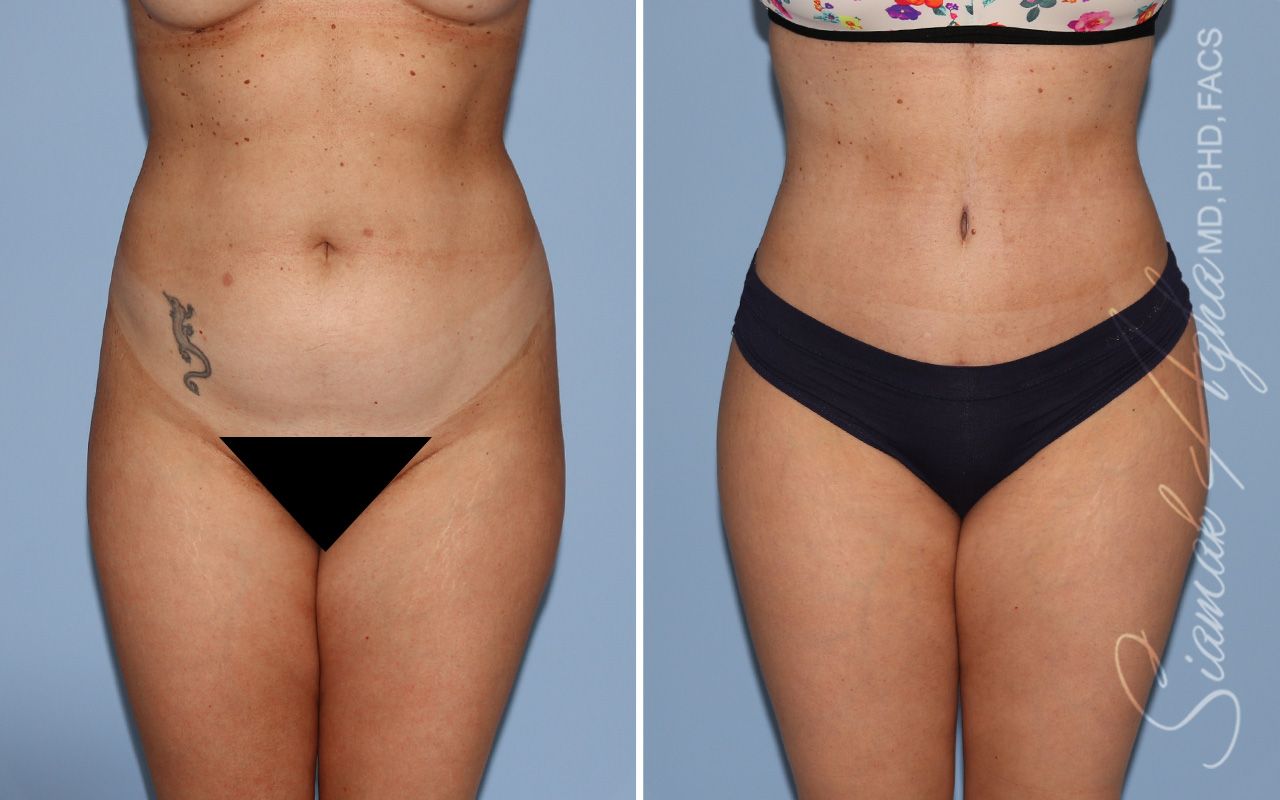 Tummy Tuck Before & After