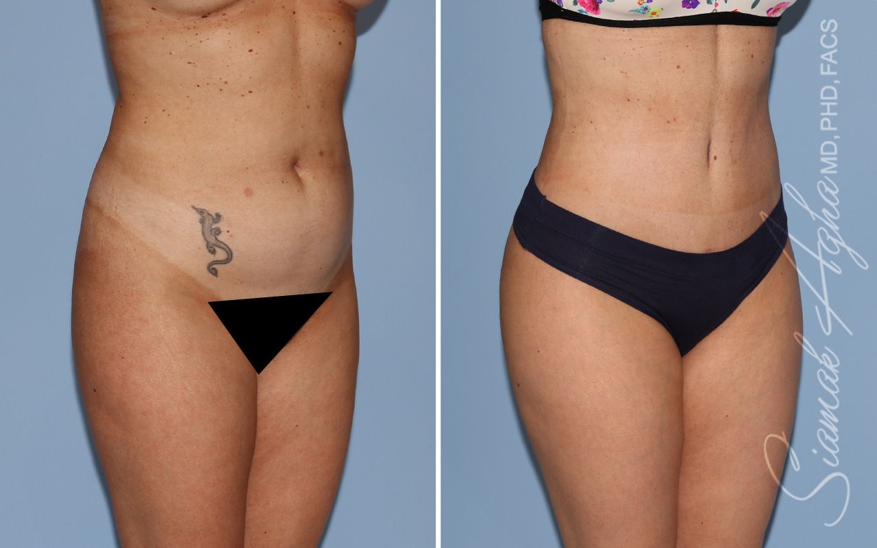 Tummy Tuck Before & After