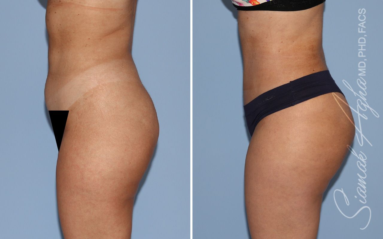 Tummy Tuck Before & After