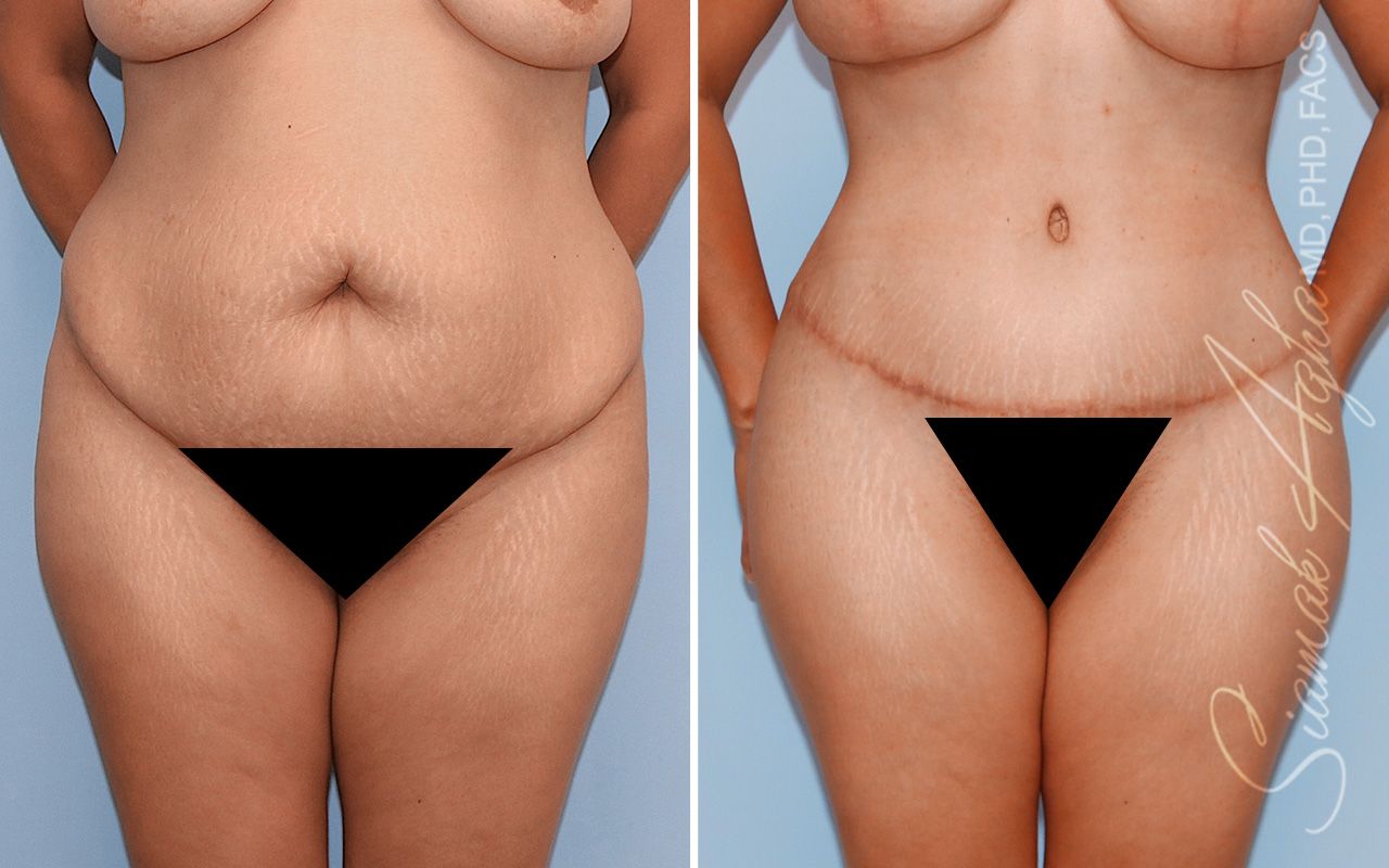 Tummy Tuck Before & After