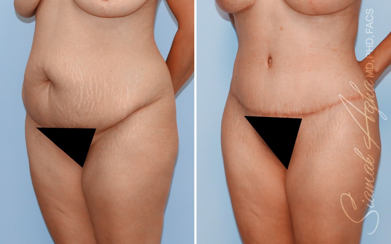 Tummy Tuck Before & After