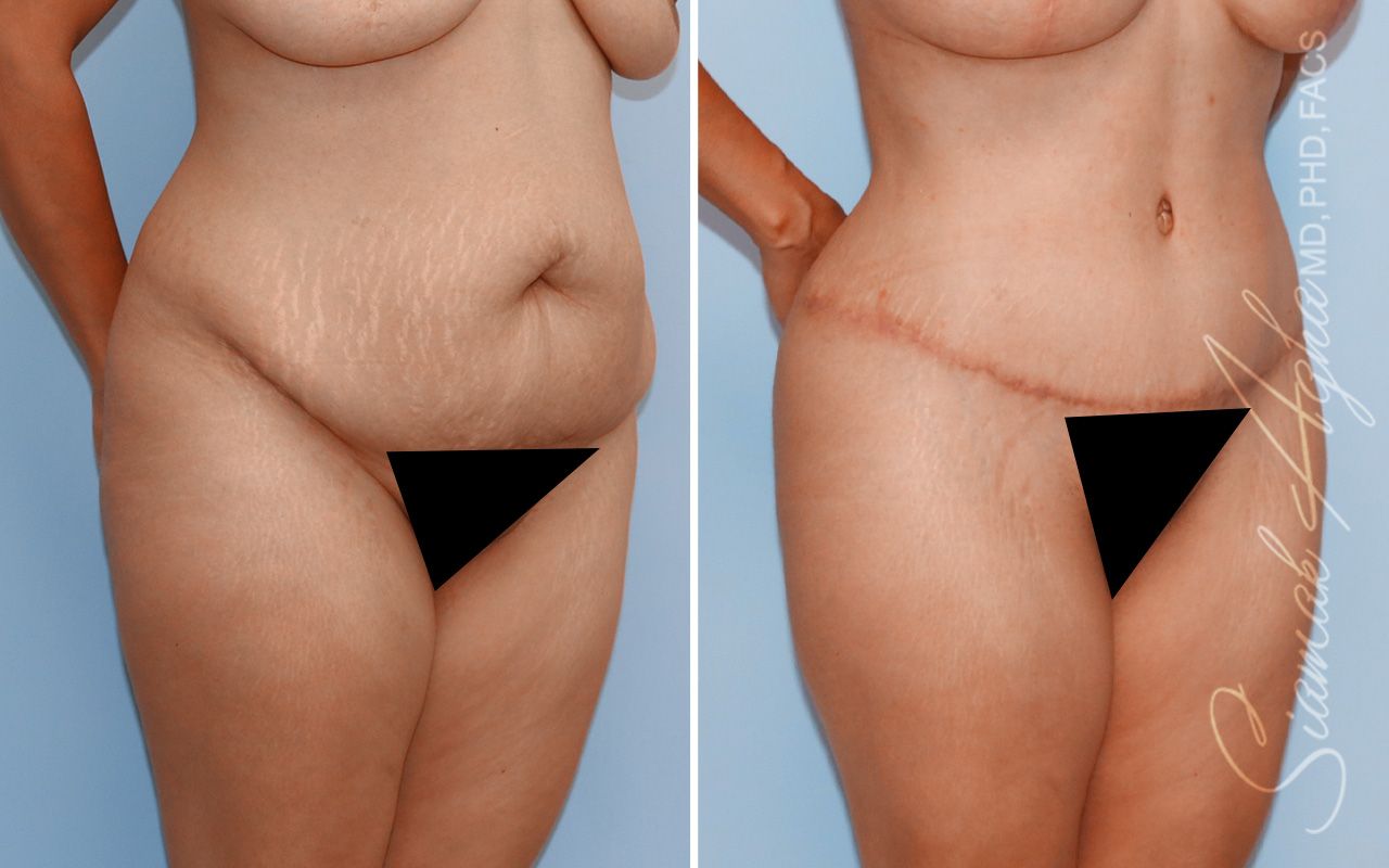 Tummy Tuck Before & After