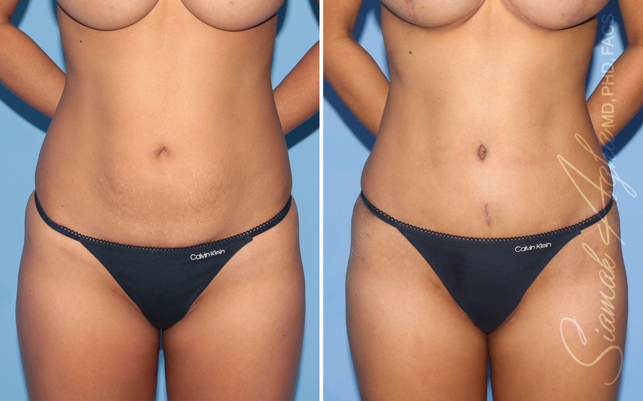 Tummy Tuck Before & After