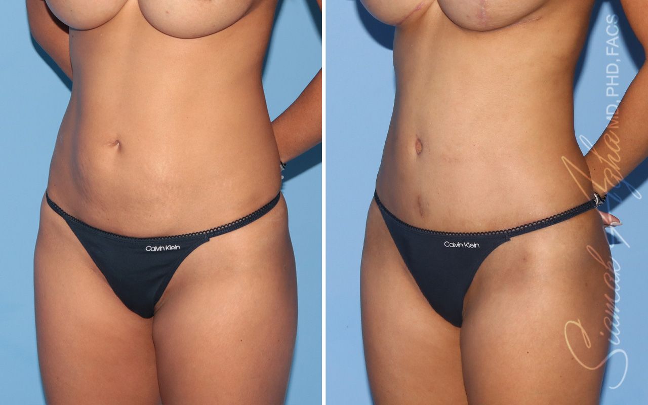 Tummy Tuck Before & After