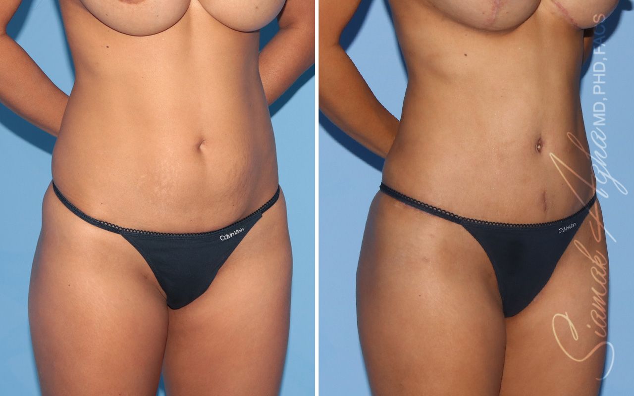 Tummy Tuck Before & After