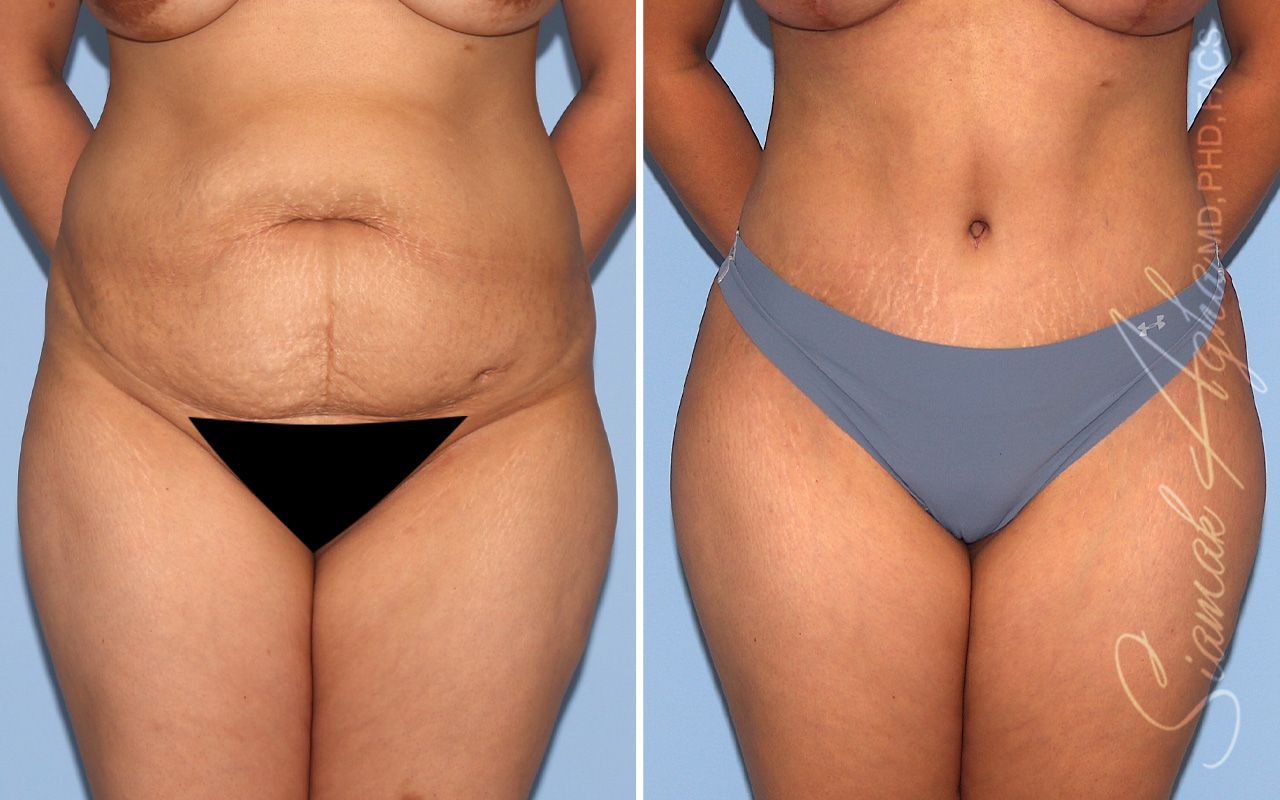 Tummy Tuck Before & After