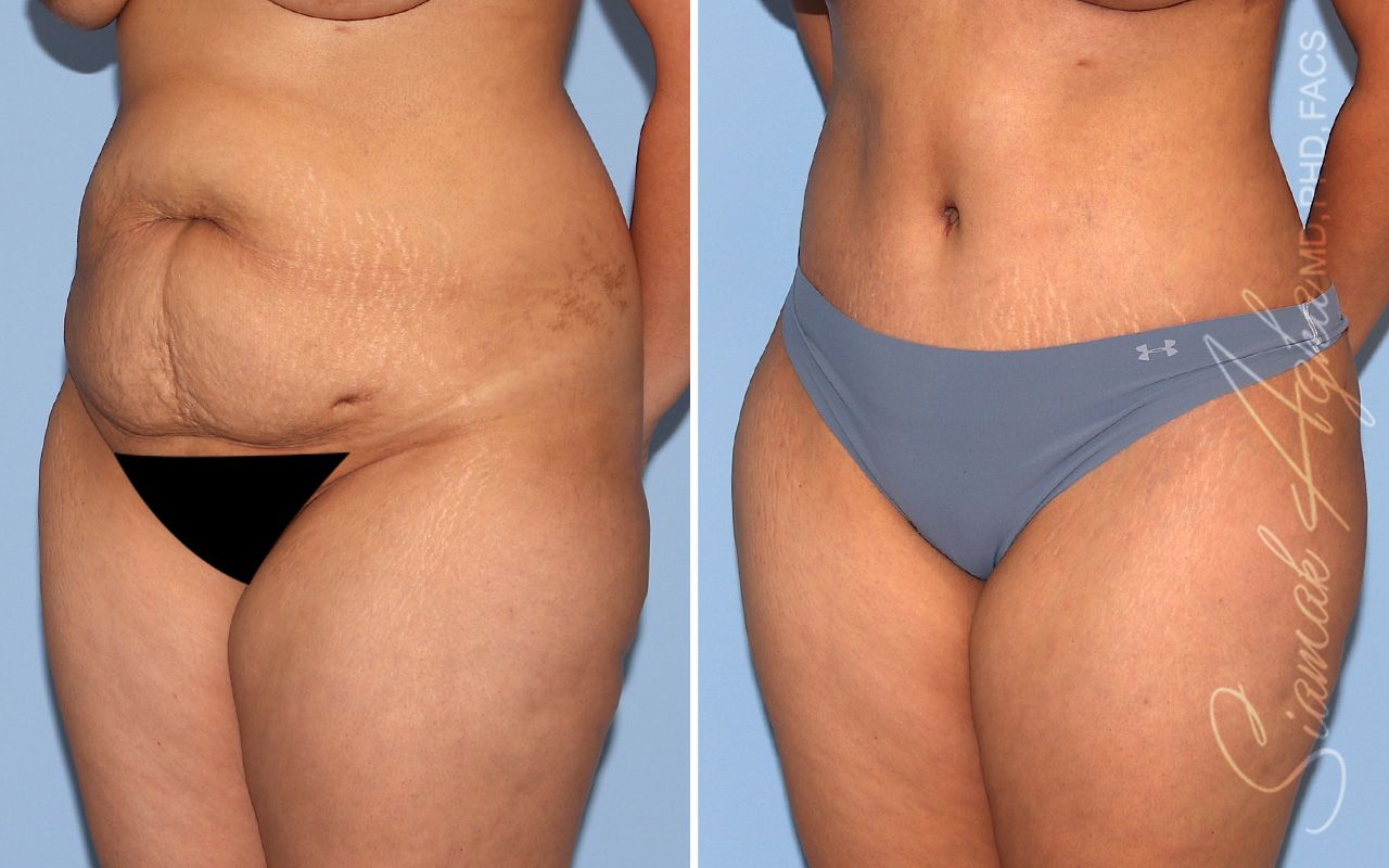 Tummy Tuck Before & After