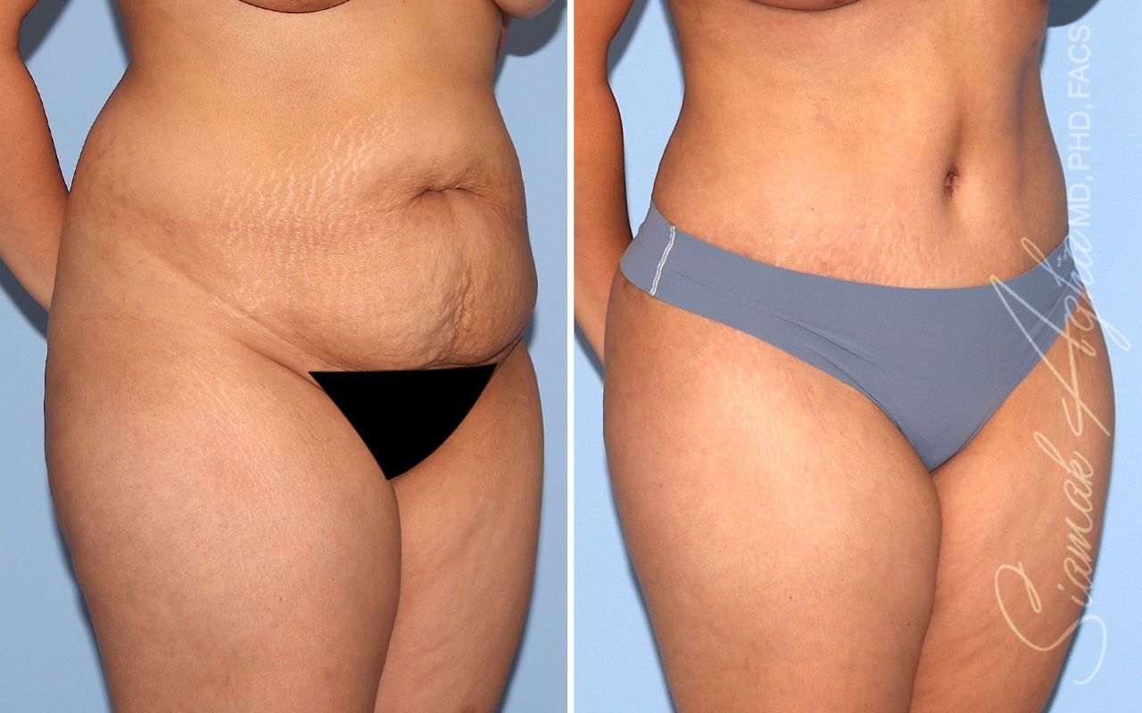 Tummy Tuck Before & After