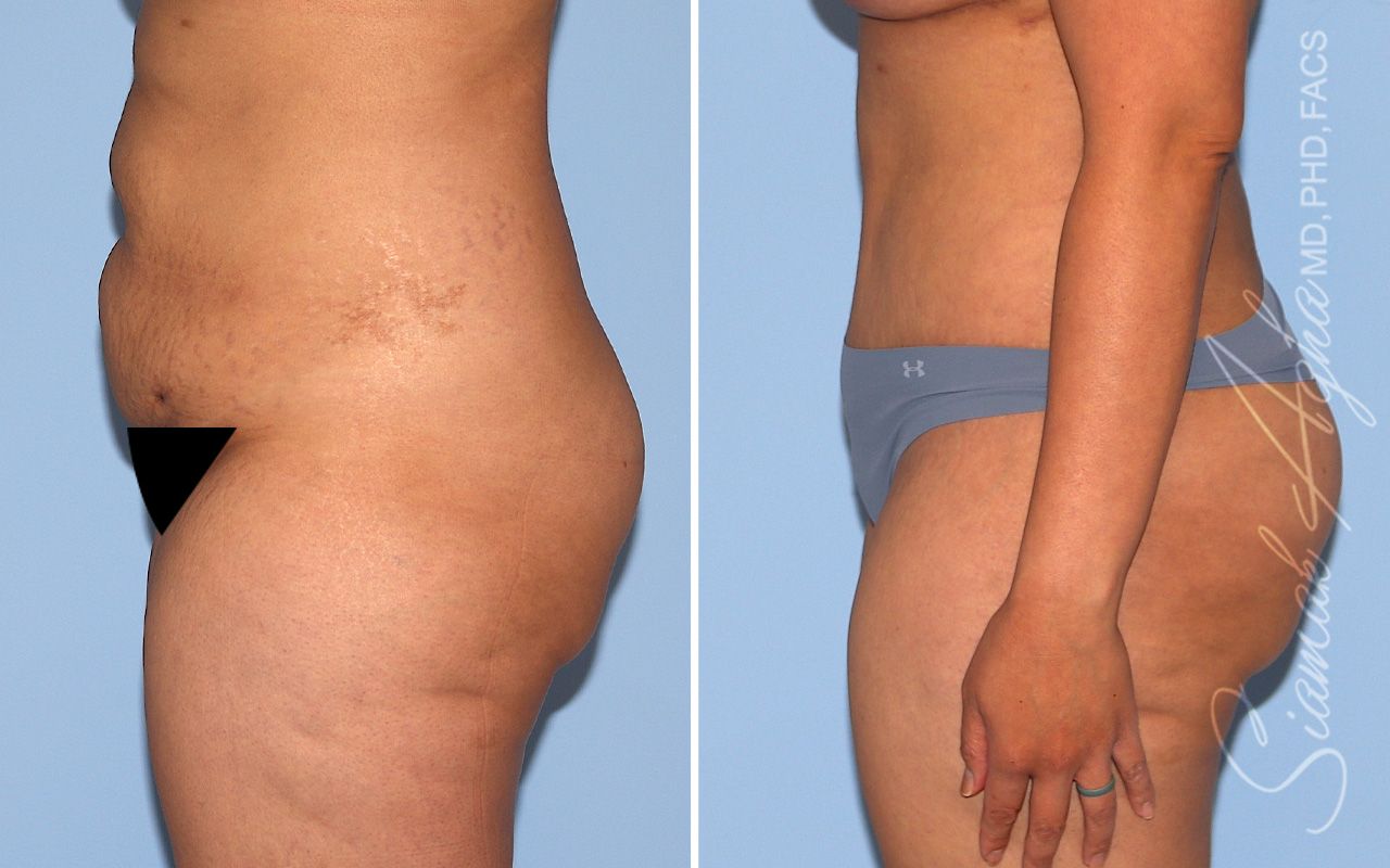 Tummy Tuck Before & After
