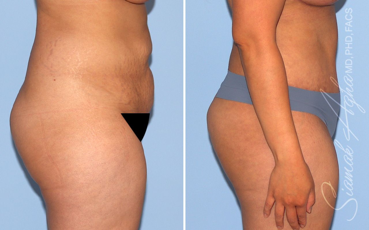 Tummy Tuck Before & After
