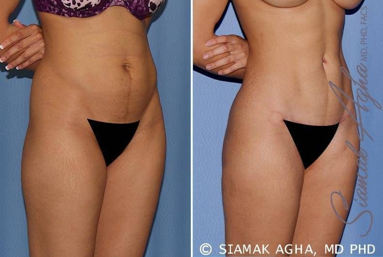 Tummy Tuck Before & After