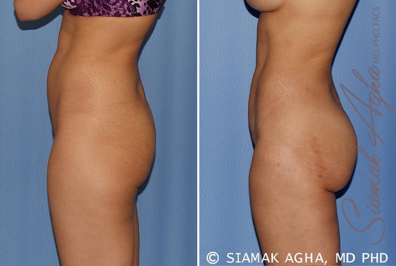 Tummy Tuck Before & After