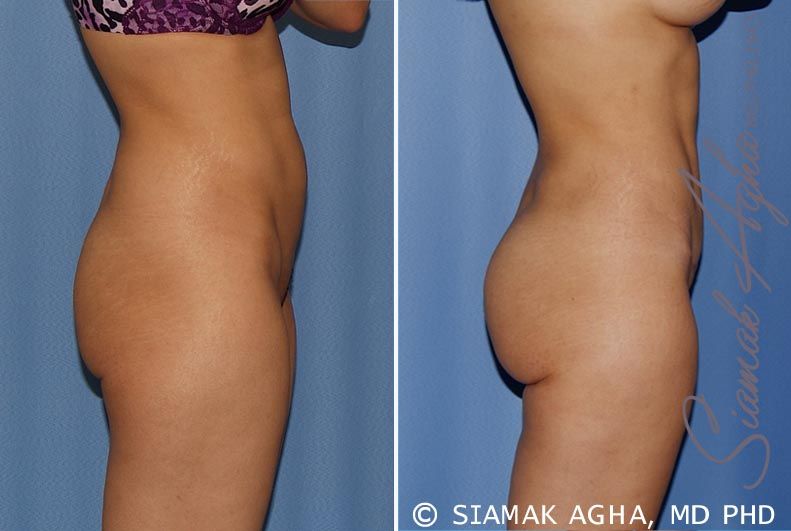 Tummy Tuck Before & After